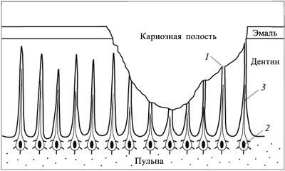 Фрагмент зуба с поврежденной эмалью: 1 – раскрытые дентинные канальцы; 2 – одонтобласты (нервные клетки); 3 – отростки одонтобластов
